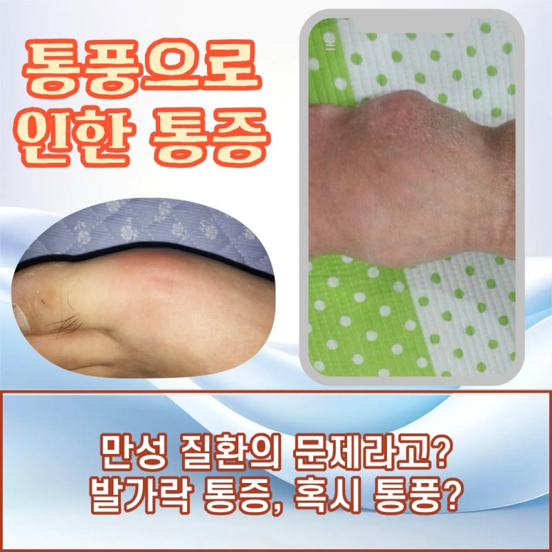 인천 강화 다치지 않았는데 검지발가락 통증이 있다면?