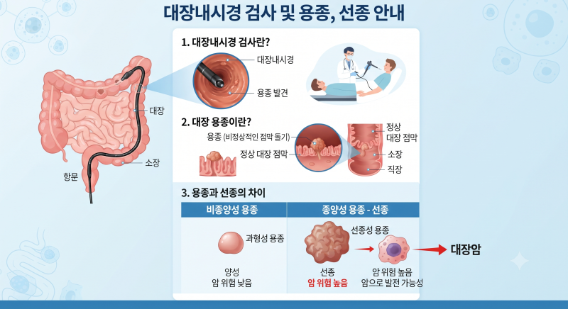 대장내시경 선종 제거 후기 & 암 예방 가이드: 선종의 위험성과 1~2년 주기 검진의 이유