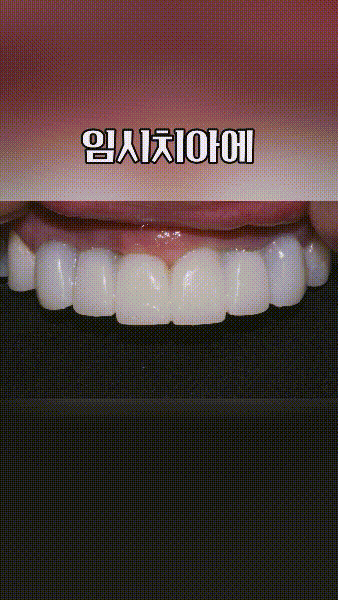 앞니 임플란트 임시치아로 6개월 버텼습니다