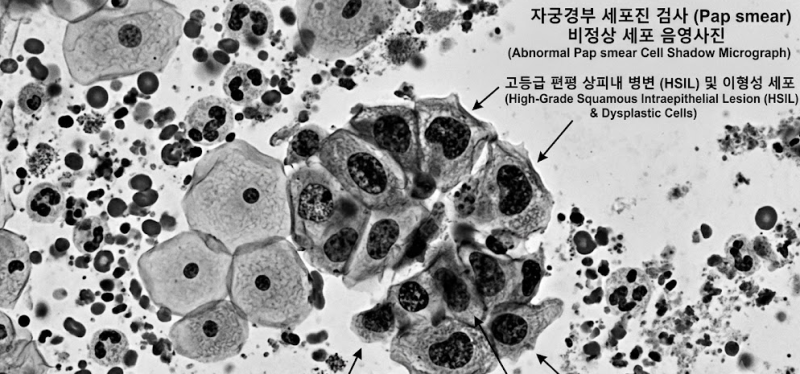 [시흥/은계 손해사정] 자궁경부 이형성증 3단계(CIN3/D06) 원추절제술 후, 보험사가 소액암이라....