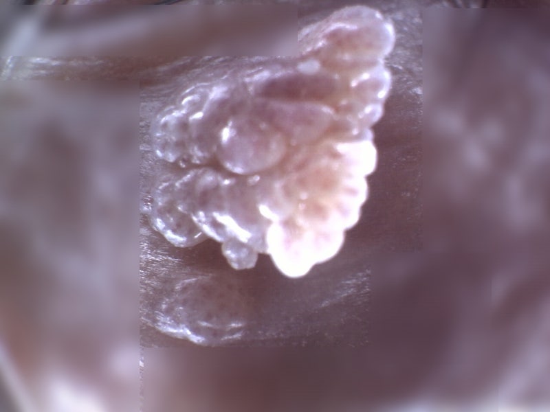 남자곤지름 자연치유 가능할까? HPV 고위험군 극복과 완치의 진실