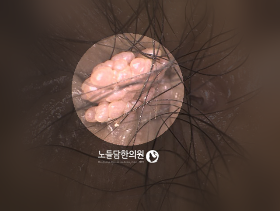 항문 곤지름 제거안하고 치료하여 통증과 재발을 막는 방법
