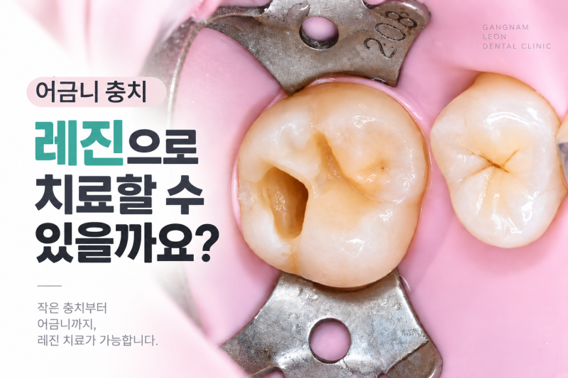 어금니 충치 레진으로 치료할 수 있을까? / 실제 레진치료 과정과 어금니 레진치료 후기 / 강....