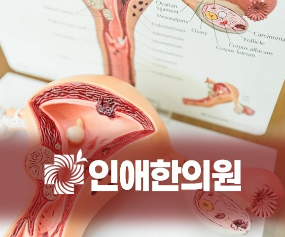 안산난소낭종 수술 꼭 필요할까? 한의원에서 치료하는 방법 궁금하다면