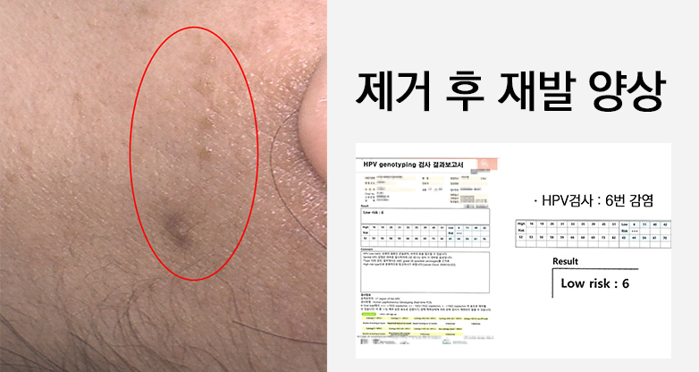편평사마귀, 제거할수록 번지는 이유? 재발 잡는 근본 치료와 전신 관리법