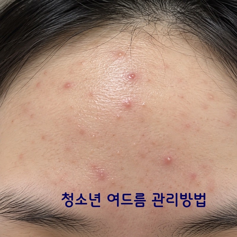 청소년 여드름 영양제 고1 피부변화