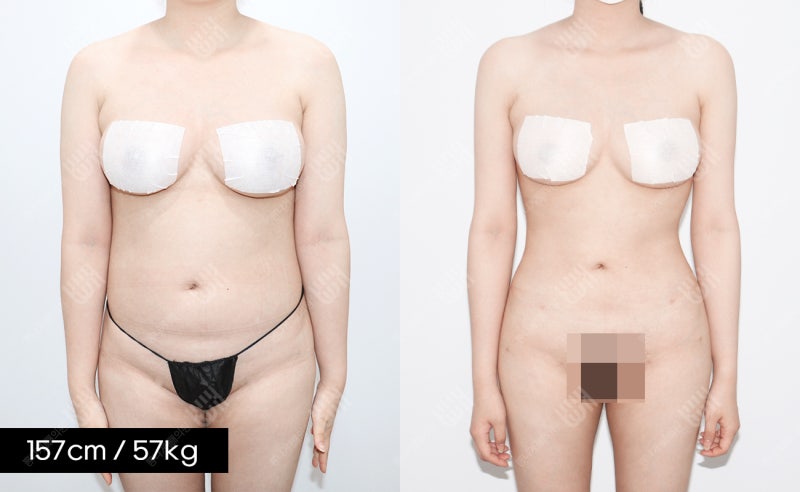 뱃살만 빼는 방법 지흡이 현실적인 이유