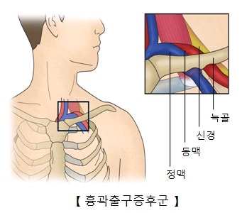 흉곽출구증후군 이란?