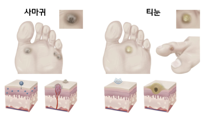 발바닥 티눈 냉동치료 실비 수술비 받을 수 있을까? 2015년 실손보험 기준과 판례 총정리