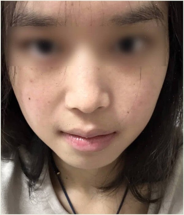 수란트라 크림 2주 써보고 나서