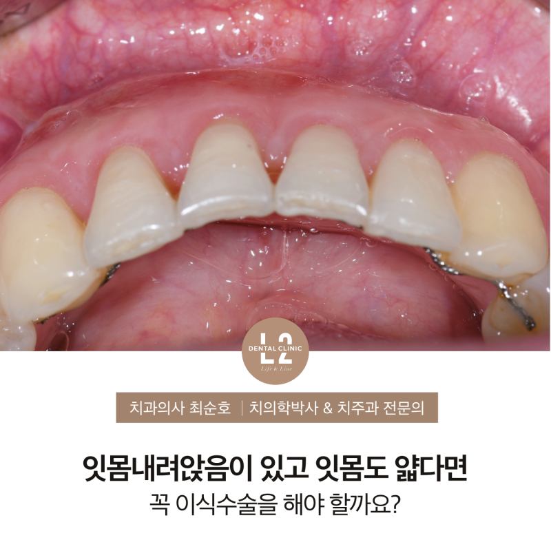 잇몸내려앉음 치료는 꼭 잇몸이식으로 해야 할까요?