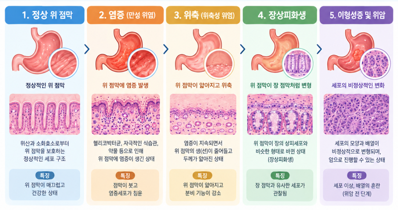 위내시경, 2년마다 받아야 하는 이유 (준비사항 · 수면내시경 · 결과 해석까지)