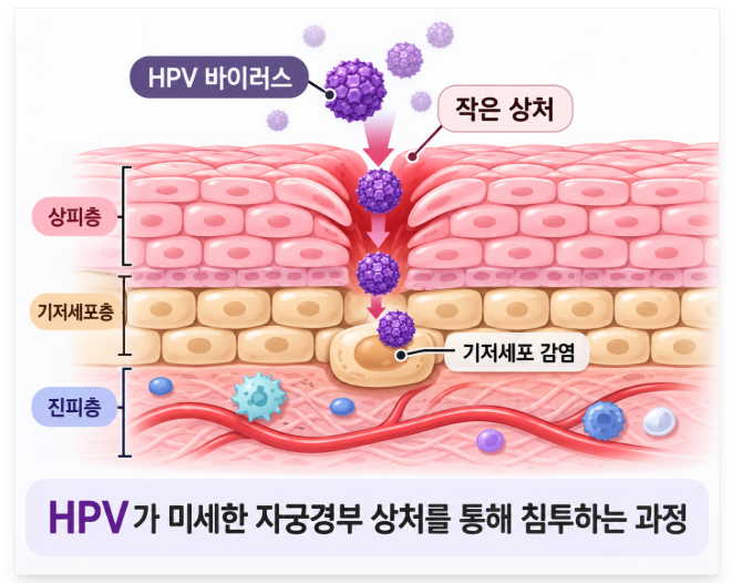 HPV 16 18 52 58 감염되었다면 완전 억제 가능할까