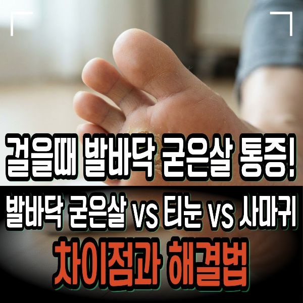 걸을때 발바닥 굳은살 통증! 발바닥 굳은살 vs 티눈 vs 사마귀 차이점과 해결법