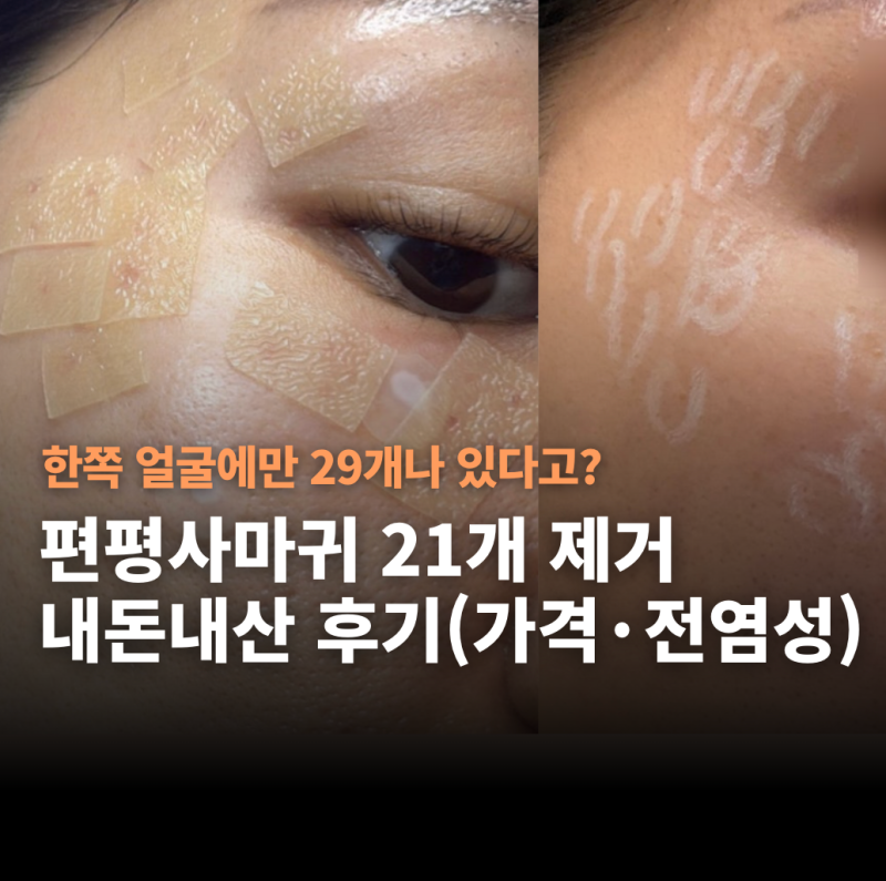 편평사마귀 21개 제거 내돈내산 후기 1편 (+편사제거 가격, 전염성)