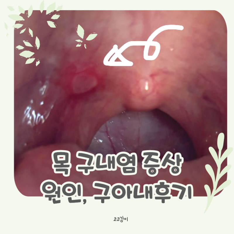 목 구내염 원인과 증상, 먹는 구내염약 구아내정 후기