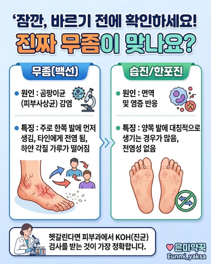 지긋지긋한 무좀 치료! 발뒤꿈치 각질, 수포형 무좀 종류별 연고 바르는 법