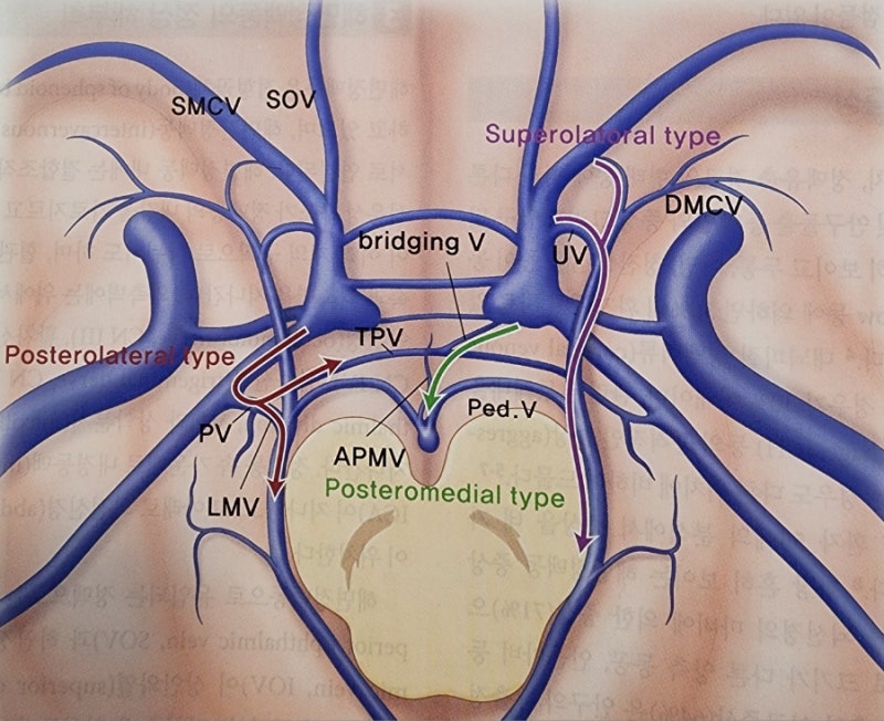 뇌혈관 기형,③ 경동맥 해면정맥루 Carotid-cavernous fistula (CCF)
