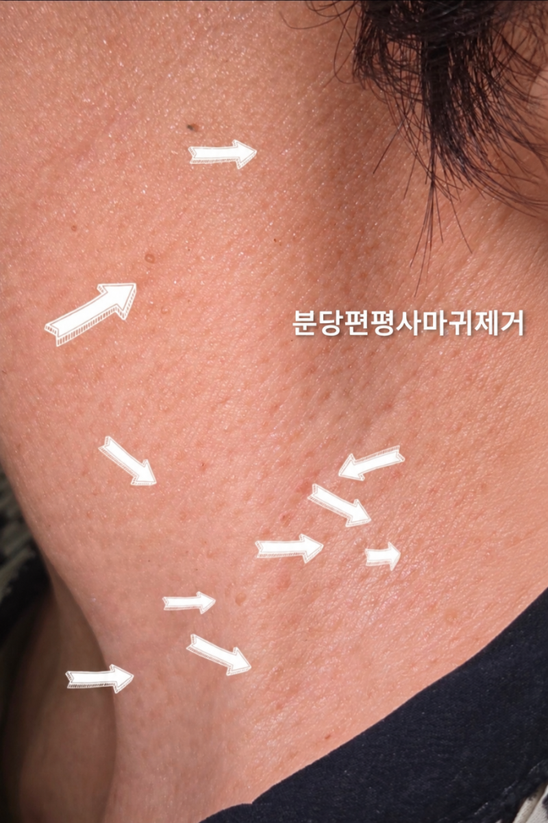 분당편평사마귀제거 얼굴, 목 7일 변화｜분당쥐젖제거 분당편평사마귀무제한 성지