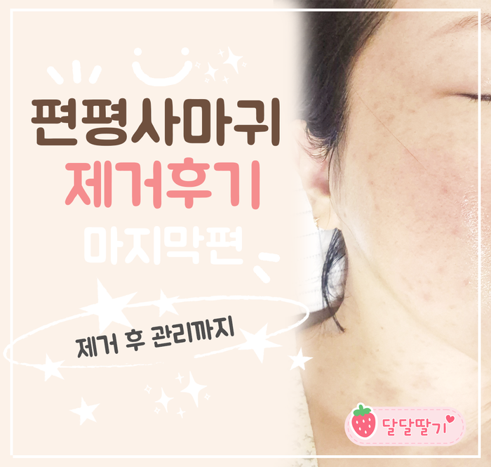편평사마귀 제거 후기 마지막편｜제거 후 관리까지 총정리