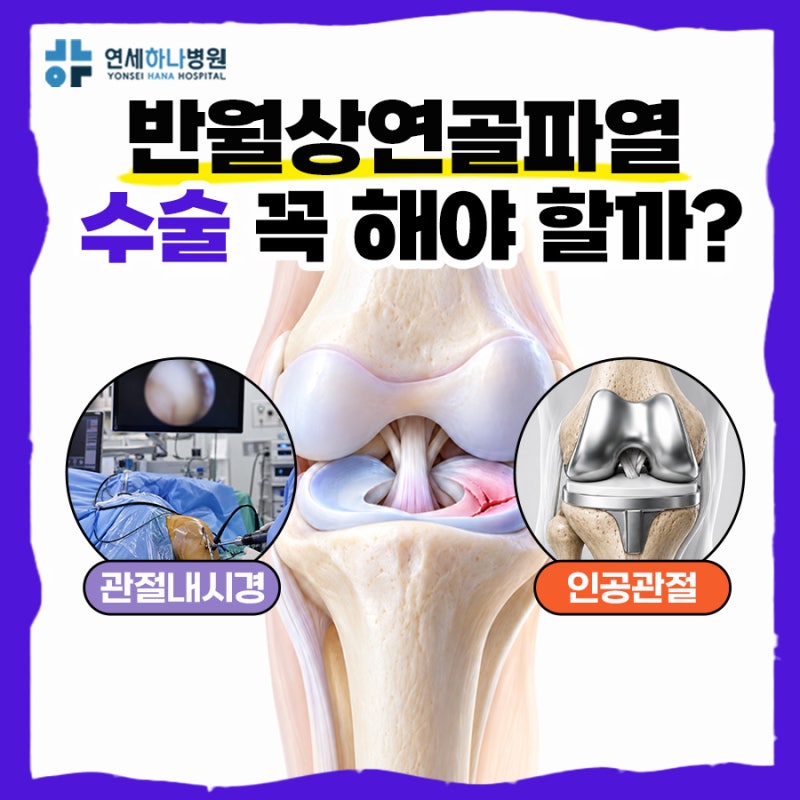 반월상연골파열수술 꼭 받아야 할까? 무릎관절내시경과 인공관절수술 차이