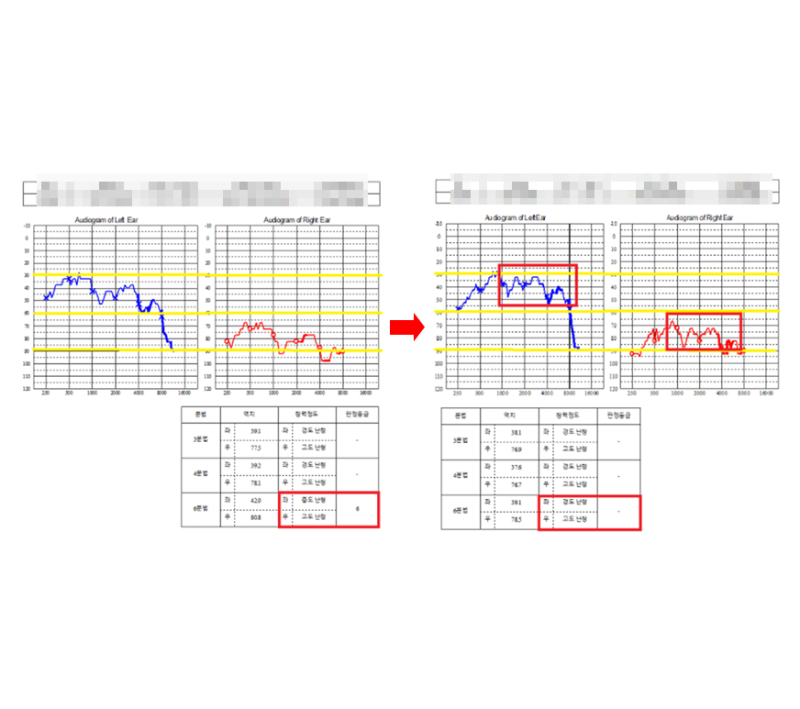 이명난청 전문병원? 5년간 멈춰있던 돌발성난청, 60대 회복 사례