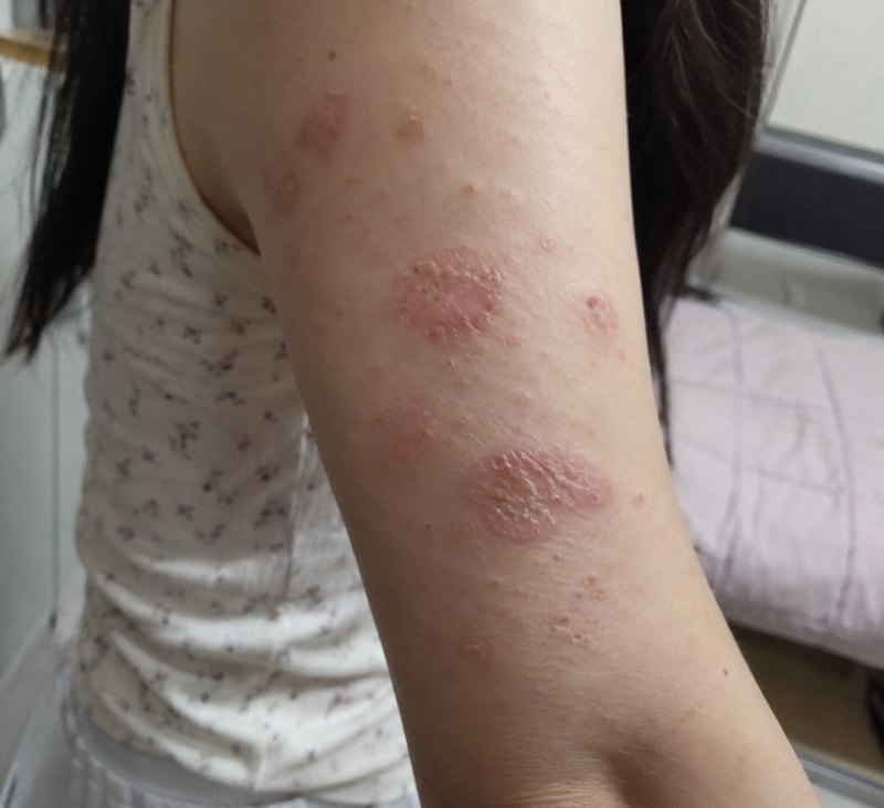성인 동전습진 증상 반점모양으로 번질 때