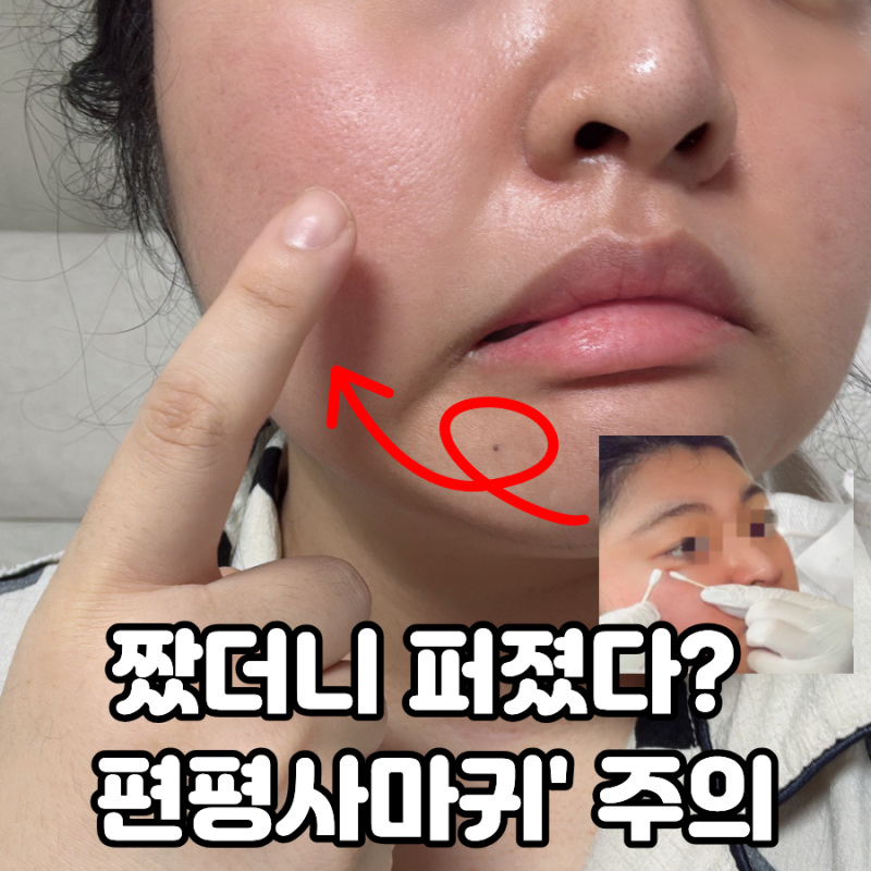 편평사마귀 원인과 해결법, 여드름인줄 알고 짜면 큰일납니다