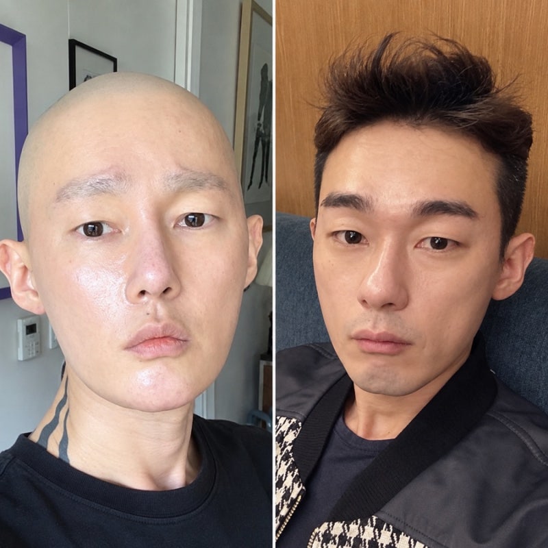 “혈액암이라고?” 허지웅도 겪은 악성 림프종, 4기 예후는 어떨까?