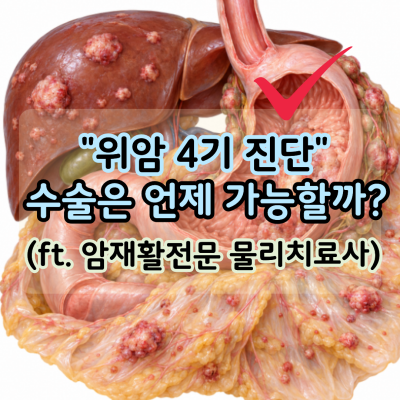 "위암 4기 진단" 수술 가능할까, 항암치료와 위암 방사선 치료 과정 (ft. 암재활전문 물리치료....