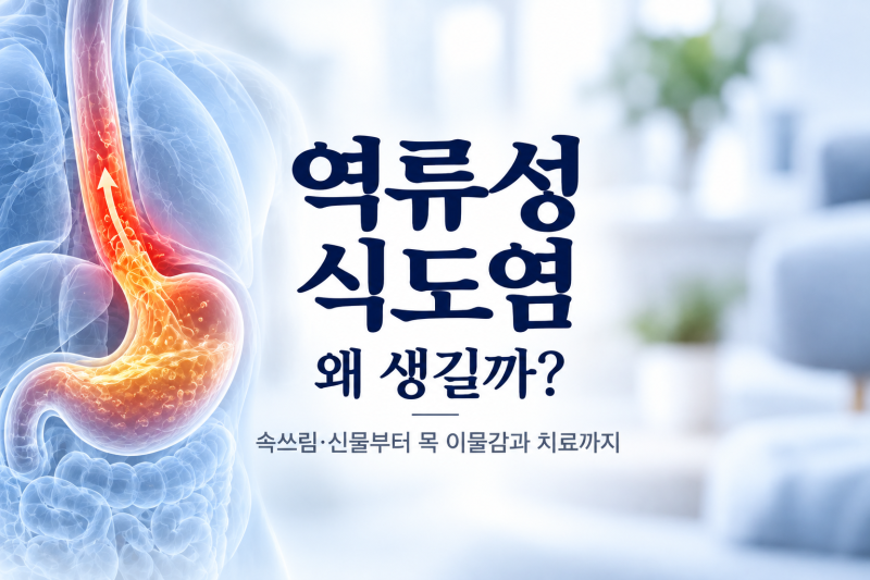 역류성 식도염은 왜 생길까? 속쓰림·신물부터 목 이물감과 치료까지