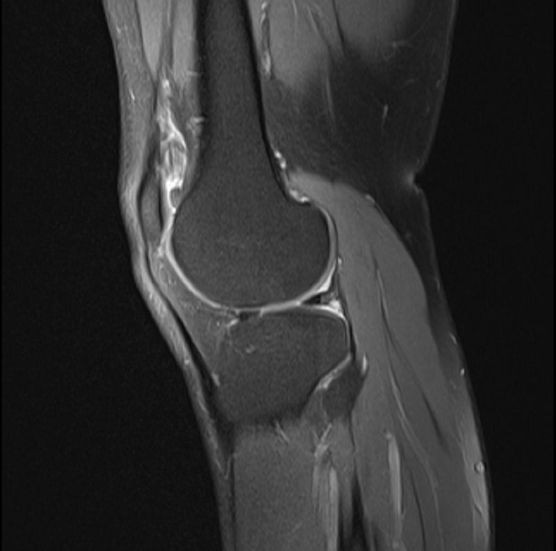 무릎 연골이 닳은 게 통증의 원인이 맞을까요? 무릎 MRI 관절연골 손상·퇴행성 관절염과 관절....