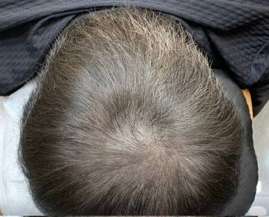 터키 모발이식 후, 탈모약 시작해야할까요? 부작용은?