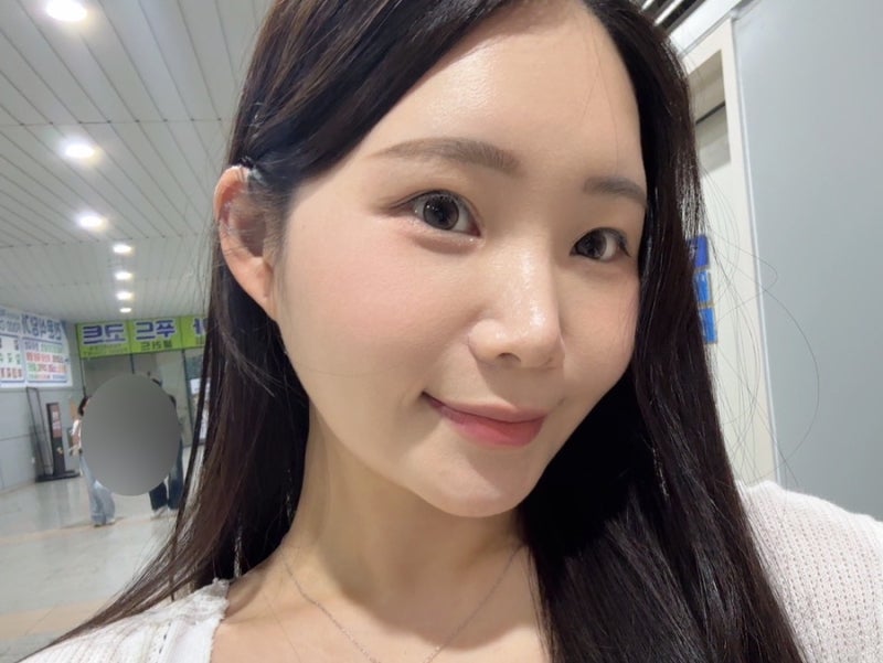 사각턱보톡스 침샘보톡스 효과, 2주차 턱라인 비교 후기