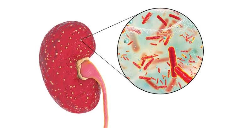 급성 신우신염(Acute Pyelonephritis) 완전정복 — 방광염과의 차이와 치료