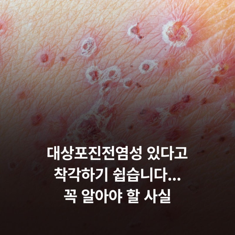 대상포진전염성 있다고 착각하기 쉽습니다...꼭 알아야 할 사실