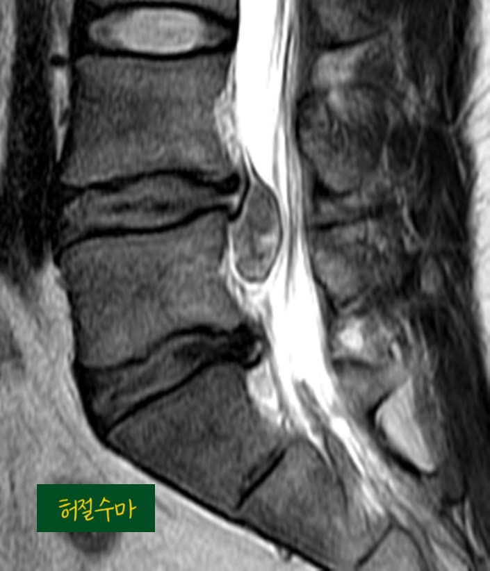 허리디스크 파열 심한 방사통과 발목 마비 (족하수), 비스테로이드 신경주사치료(신경차단술....