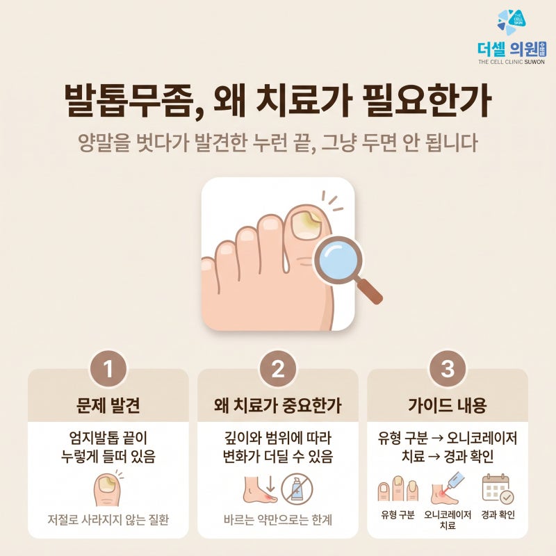 우만동 발톱무좀병원, 두꺼워진 발톱 오니코레이저로 접근하는 방법