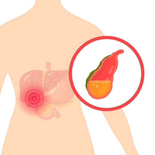 담장 용종 크기 1cm 수술해야 할까? 암 위험성과 무흉터 담낭절제술 가이드 Q&A