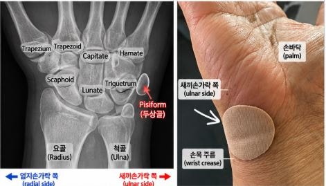 내 손목의 콩알, 수근골