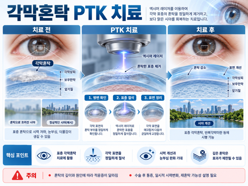 라식·라섹 후 각막혼탁 PTK 치료 실손보험