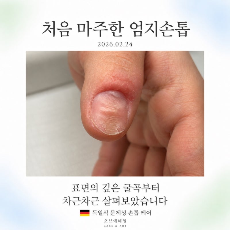대구 문제성 손톱 케어｜물어뜯는 손톱 교정 5회 관리 후 누드톤 자석젤까지