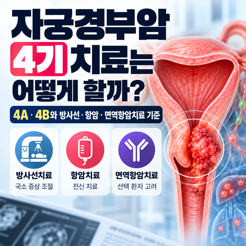 자궁경부암 4기 치료는 어떻게 할까? 4A·4B와 방사선·항암·면역항암치료 기준