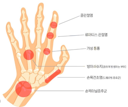 손가락 마디 통증 생겼을 때 집에서 하는찜질·마사지