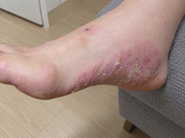 발바닥 한포진 신발 벗기 싫어질 때쯤 보세요
