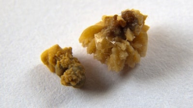 서울 요로결석 응급 치료 가능한 비뇨기과 의원은? 24시간 진료 병원 정리 (서울N비뇨기과 블....