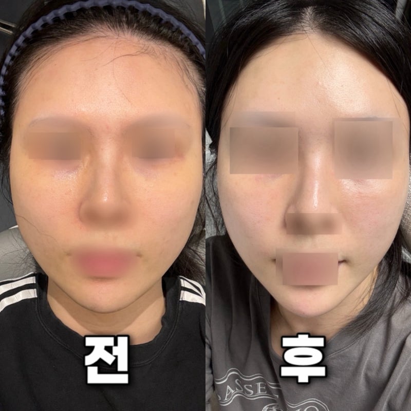 대구 편평사마귀 성지 후기 2️⃣탄 | 점•쥐젖•비립종 제거 2주 후 피부 변화
