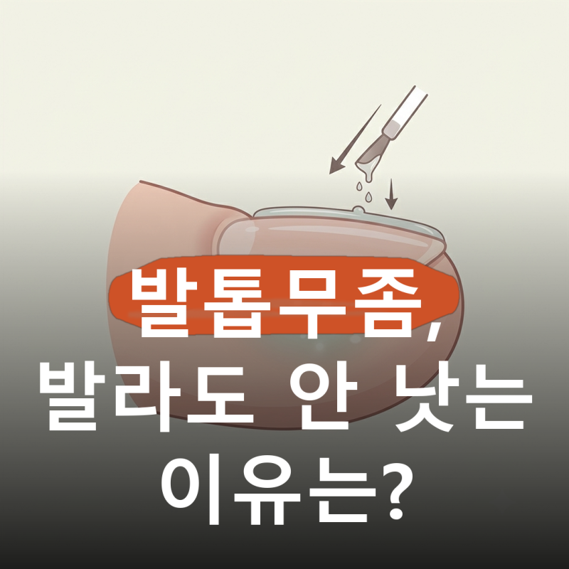몇 년째 바르고 있는데 그대로라면.. 발톱무좀에 바르는 약만으로는 어려운 이유와 걸리는 ....