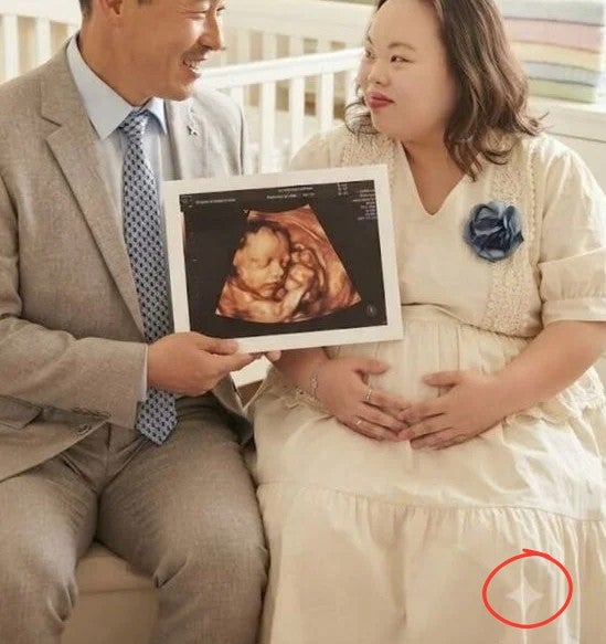 "임신 아니다" 다운증후군 서은혜 父 직접 해명...초음파 사진은 '제미나이' 생성