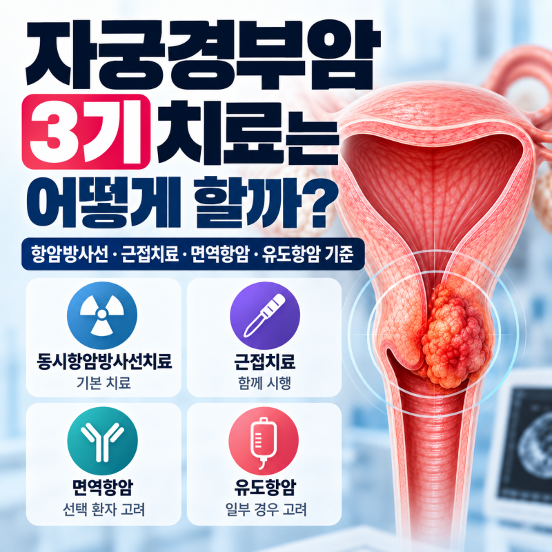 자궁경부암 3기 치료는 어떻게 할까? 항암방사선·근접치료·면역항암·유도항암 기준